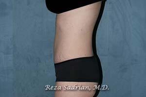 Tummy Tuck Before & After Image