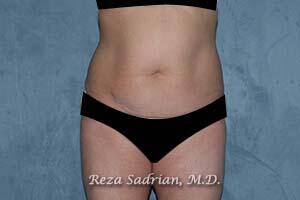 Tummy Tuck Before & After Image