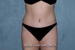 Tummy Tuck Before & After Image