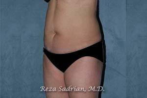 Tummy Tuck Before & After Image