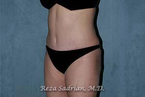 Tummy Tuck Before & After Image