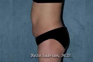 Tummy Tuck Before & After Image