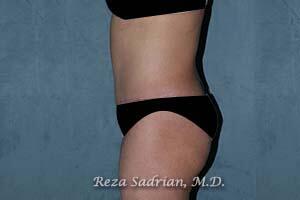 Tummy Tuck Before & After Image