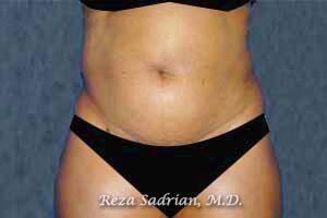 Tummy Tuck Before & After Image