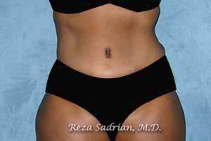 Tummy Tuck Before & After Image