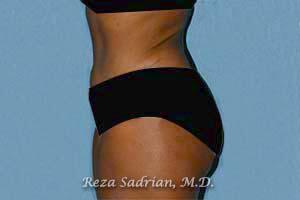 Tummy Tuck Before & After Image