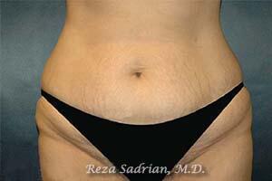 Tummy Tuck Before & After Image