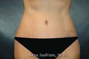 Tummy Tuck Before & After Image