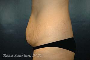 Tummy Tuck Before & After Image