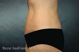 Tummy Tuck Before & After Image