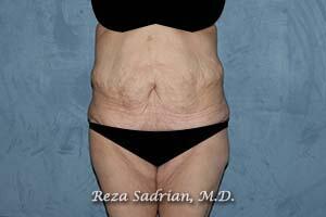 Tummy Tuck Before & After Image