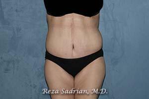 Tummy Tuck Before & After Image