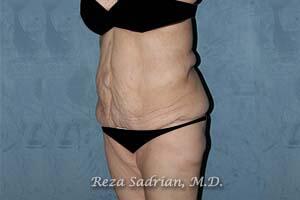 Tummy Tuck Before & After Image