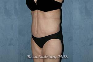 Tummy Tuck Before & After Image