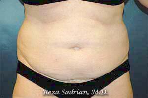 Tummy Tuck Before & After Image