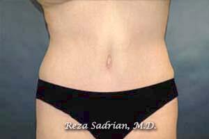 Tummy Tuck Before & After Image