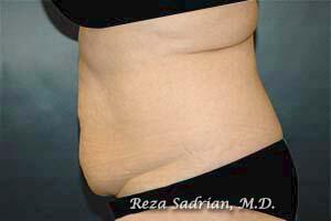 Tummy Tuck Before & After Image