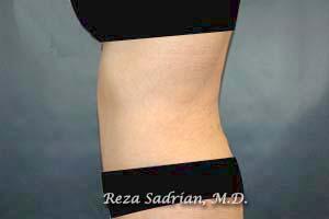 Tummy Tuck Before & After Image