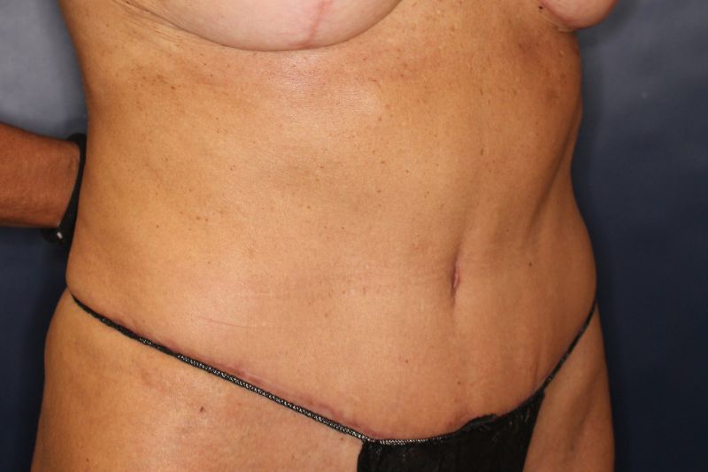 Tummy Tuck Before & After Image