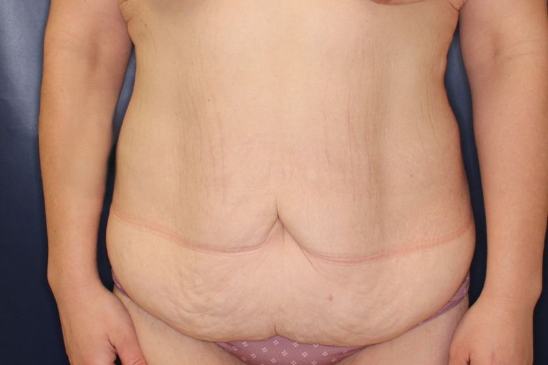 Tummy Tuck Before & After Image