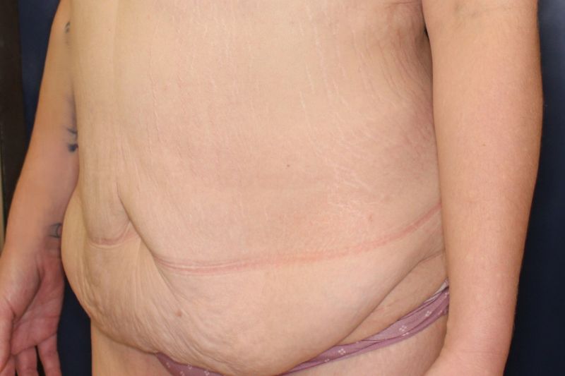 Tummy Tuck Before & After Image