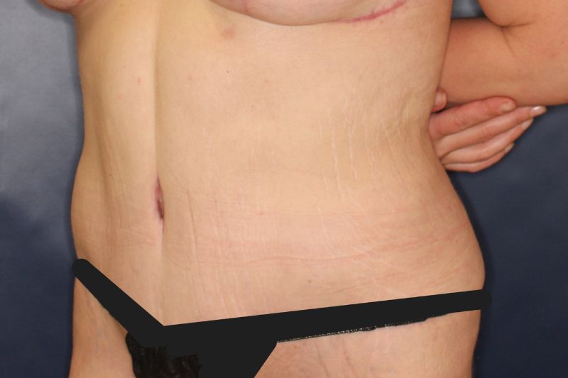 Tummy Tuck Before & After Image