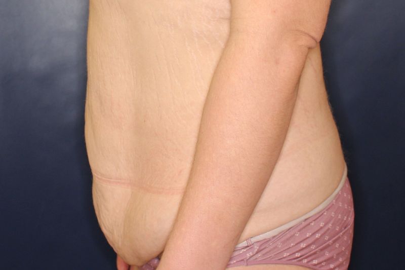 Tummy Tuck Before & After Image