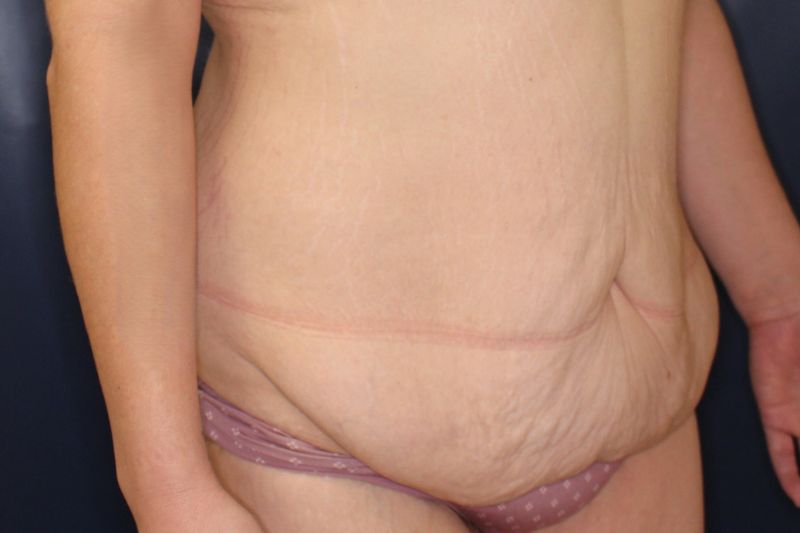 Tummy Tuck Before & After Image