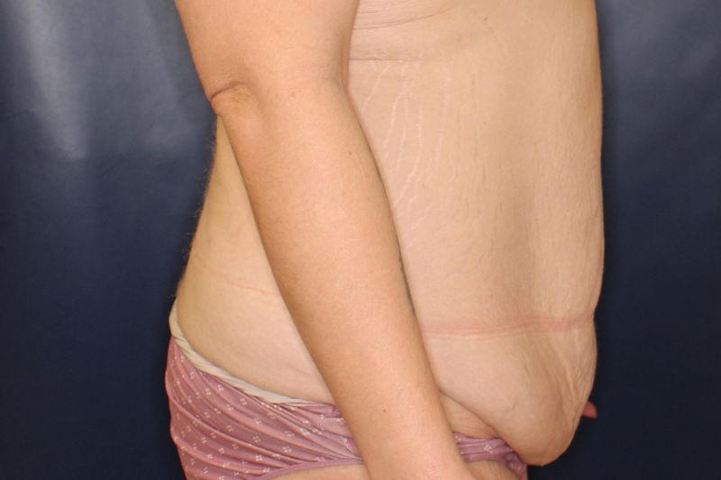 Tummy Tuck Before & After Image