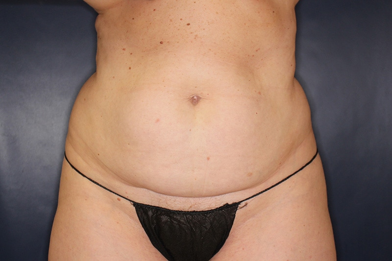 Tummy Tuck Before & After Image