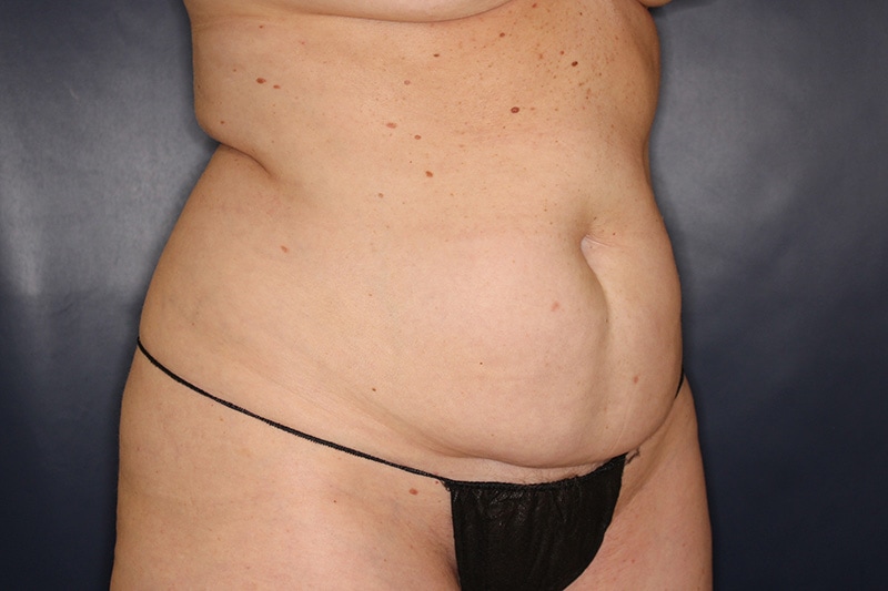 Tummy Tuck Before & After Image