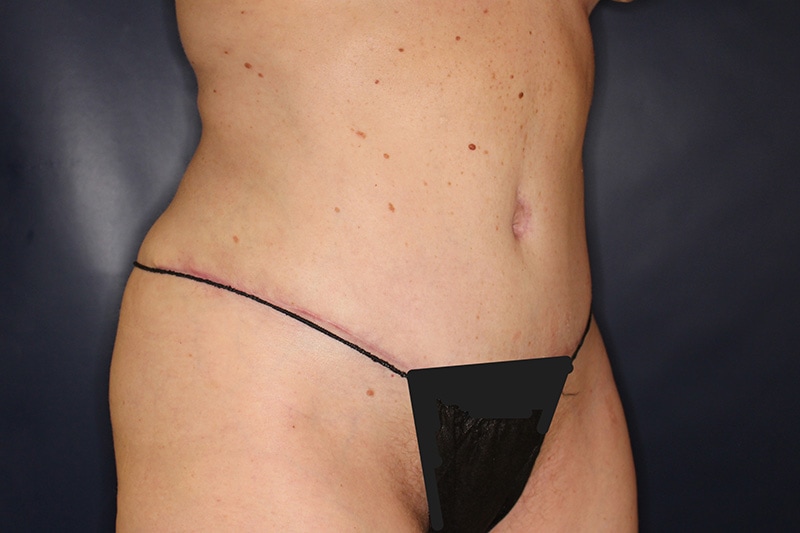 Tummy Tuck Before & After Image