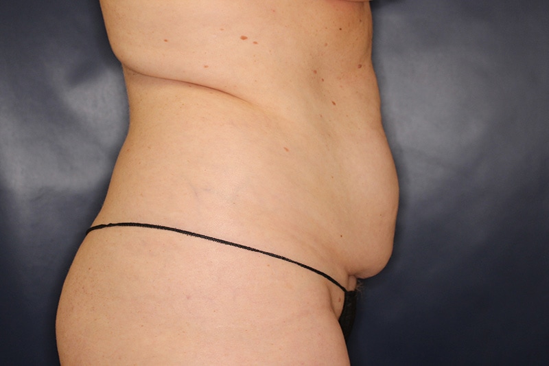 Tummy Tuck Before & After Image