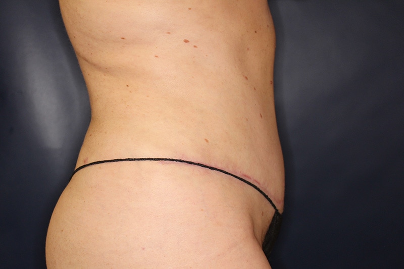 Tummy Tuck Before & After Image