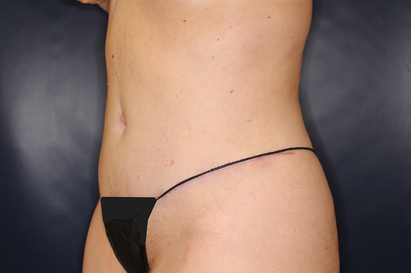 Tummy Tuck Before & After Image