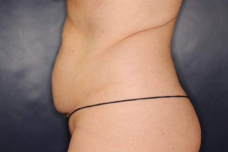 Tummy Tuck Before & After Image