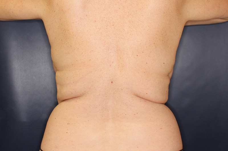 Tummy Tuck Before & After Image