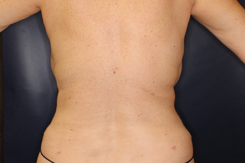 Tummy Tuck Before & After Image