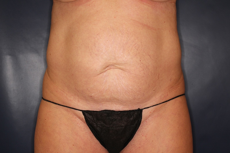 Tummy Tuck Before & After Image