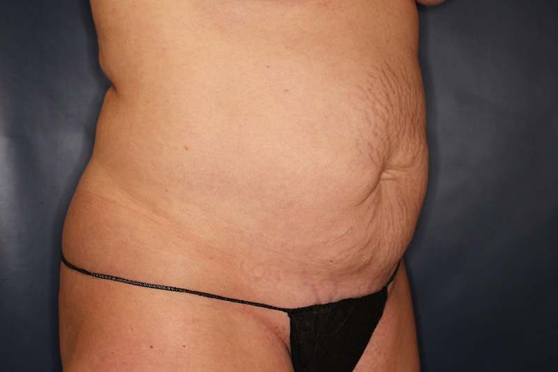 Tummy Tuck Before & After Image