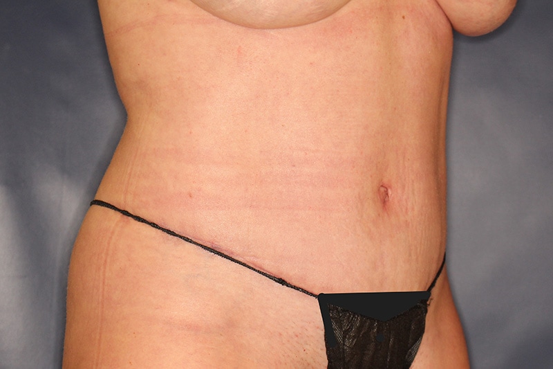 Tummy Tuck Before & After Image