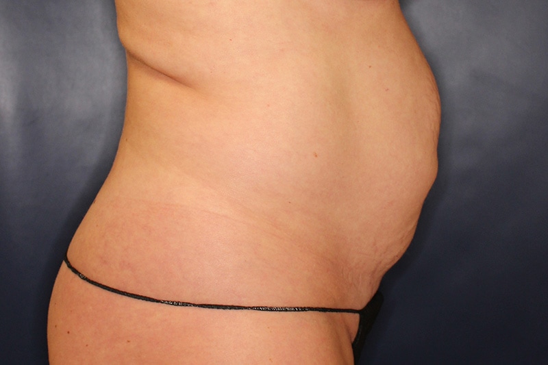 Tummy Tuck Before & After Image