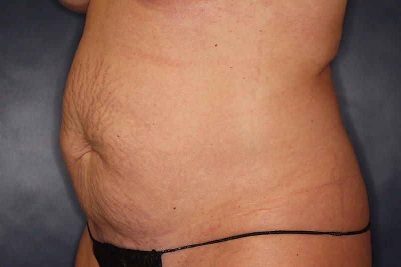Tummy Tuck Before & After Image