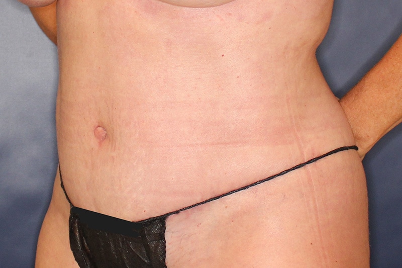Tummy Tuck Before & After Image
