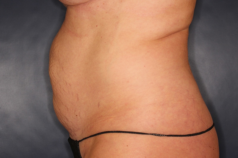 Tummy Tuck Before & After Image