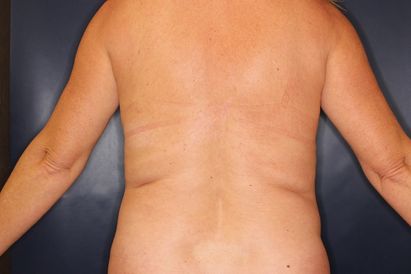 Tummy Tuck Before & After Image
