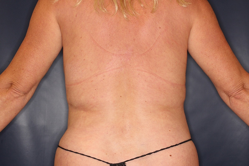 Tummy Tuck Before & After Image