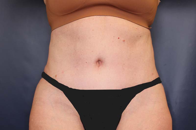 Tummy Tuck Before & After Image
