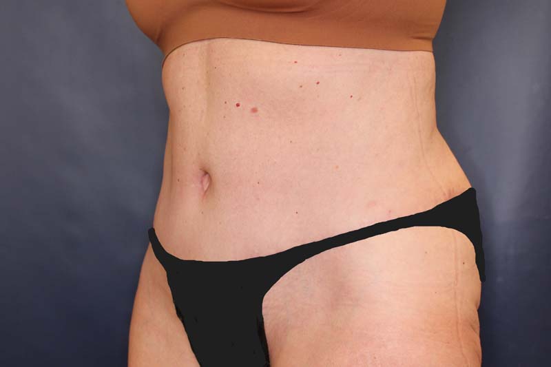 Tummy Tuck Before & After Image