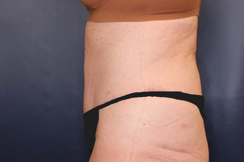 Tummy Tuck Before & After Image